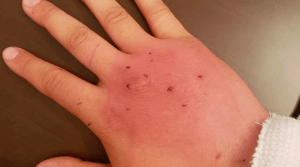 Is a Cat's Bite Dangerous?