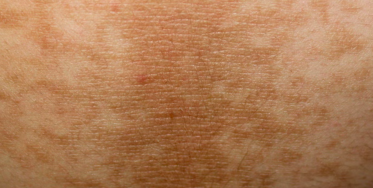 Dark Patches of Skin