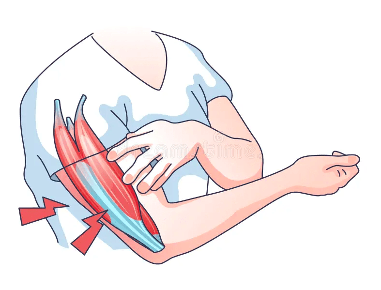 Muscle Pain and Weakness