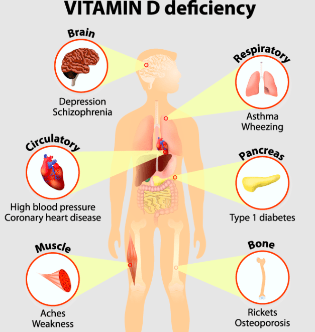 vitamin D deficiency