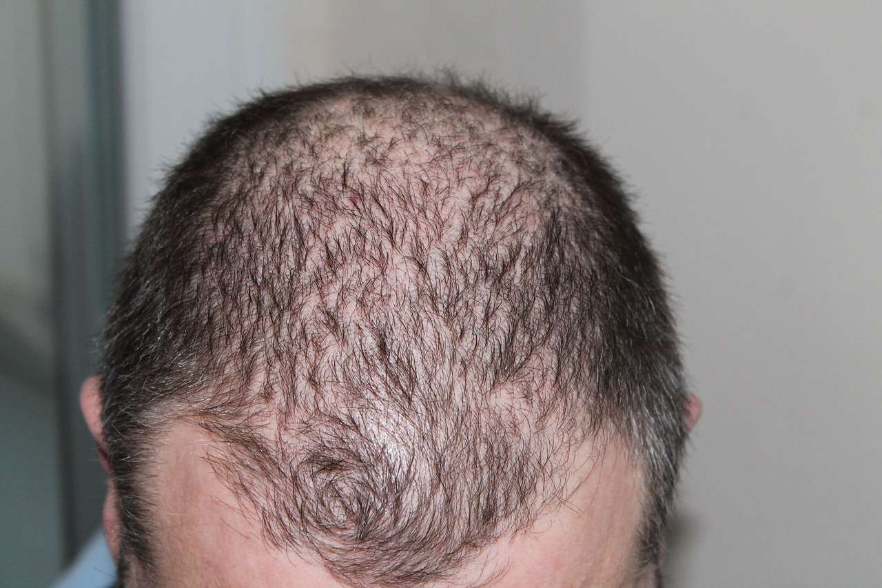 You are currently viewing What is Hair Loss Treatment at Home?