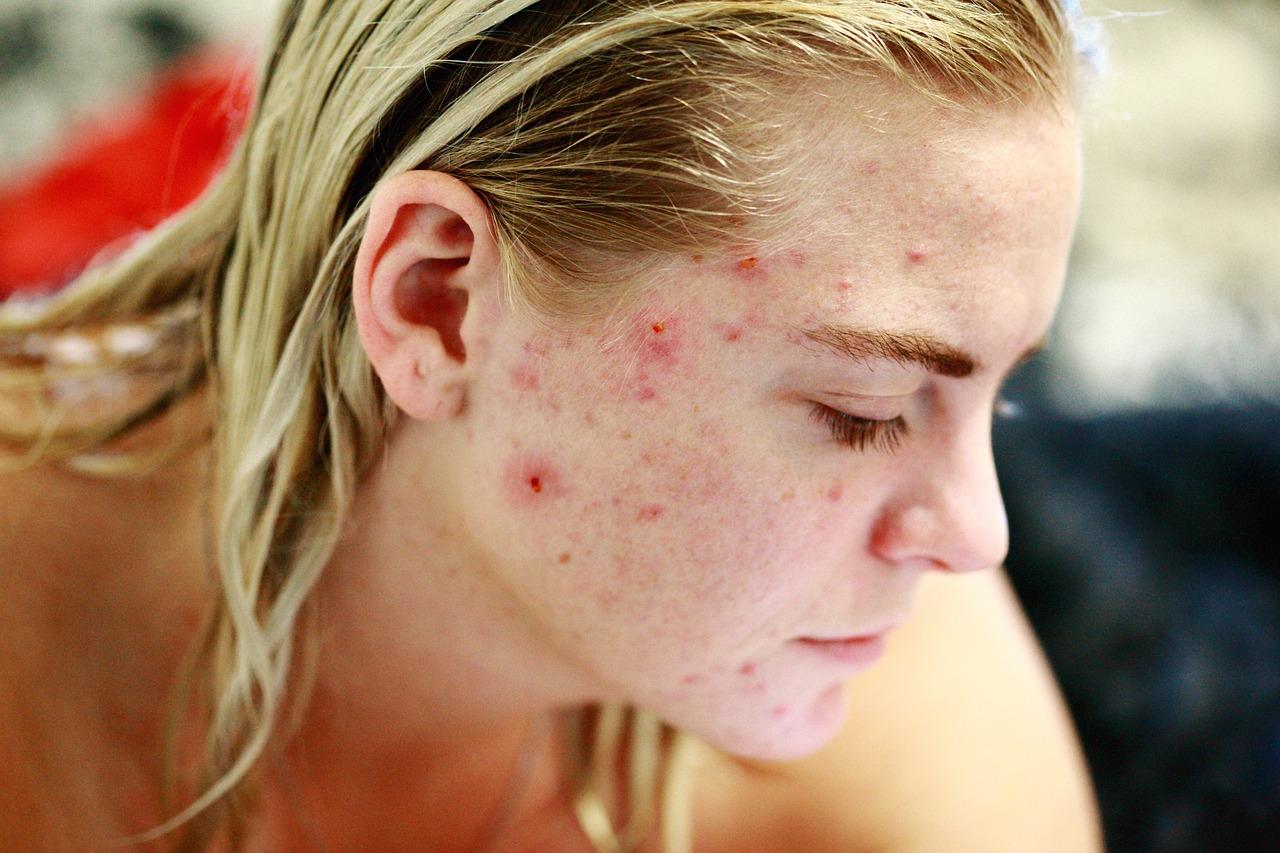 You are currently viewing Is the whole face covered in acne? Reduce immediately!