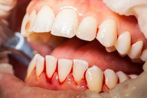 Read more about the article Home Remedies to Stop Bleeding Gums