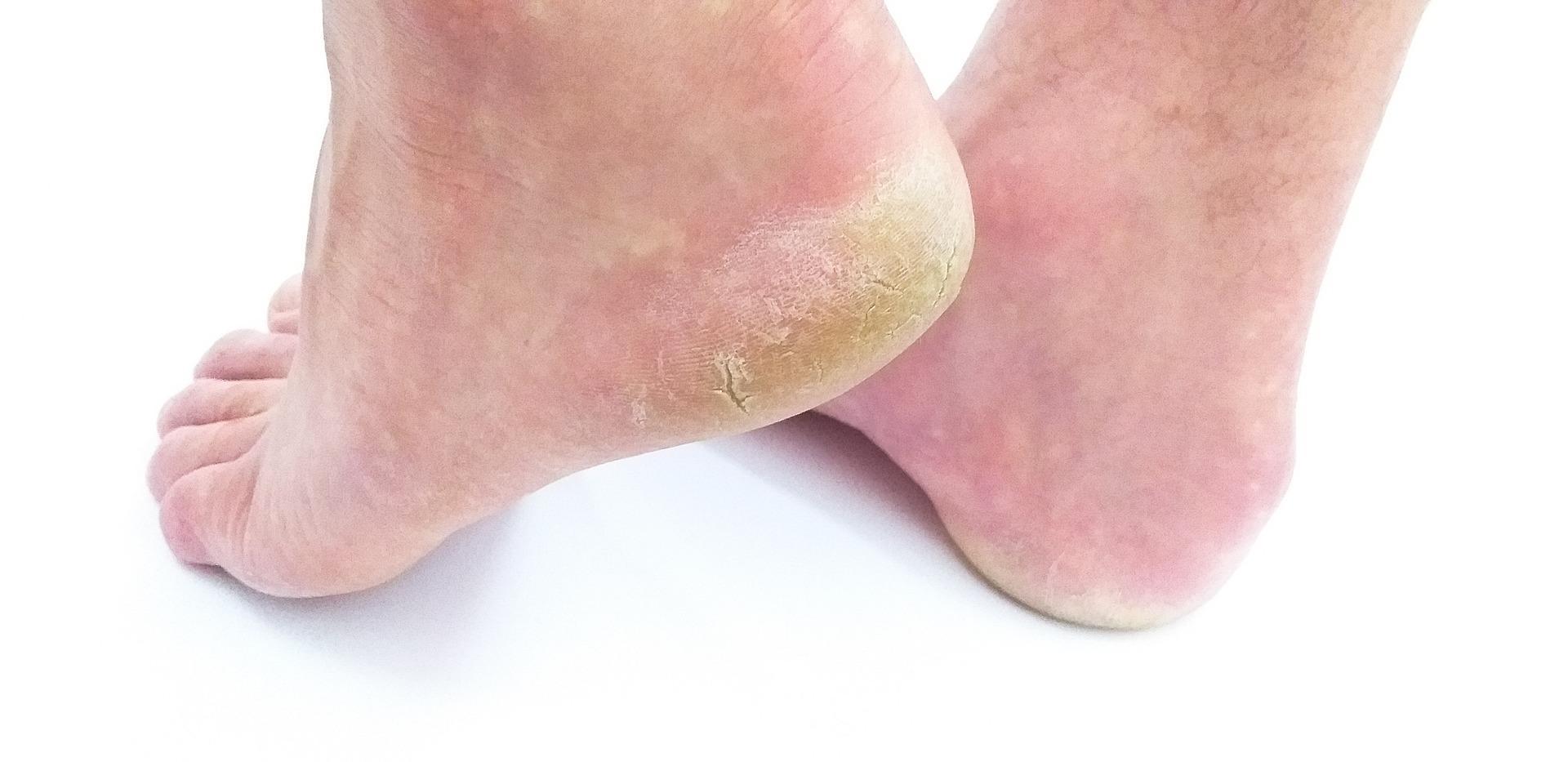 Read more about the article 5 Ways to Stop Cracked Heels in Just One Week