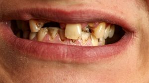 signs of poor oral and dental health