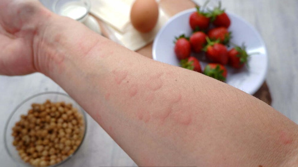 Read more about the article Food allergies. Are you suffering from 4 types of food unknowingly?