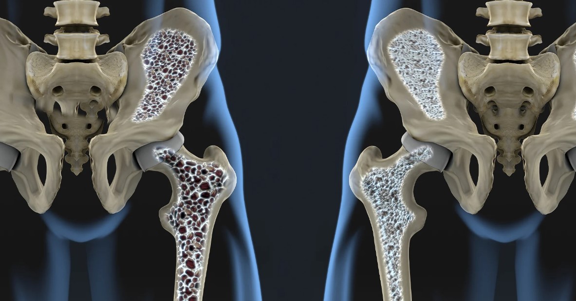 You are currently viewing Reasons for osteoporosis in ladies, side effects and ways of overseeing torment