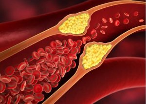 Read more about the article Do you know the causes, risks, and control of 3 types of cholesterol in the blood?