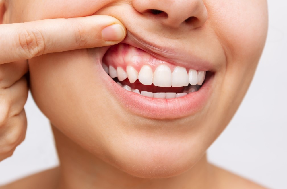 Read more about the article Dental Gum Care for Healthy Life