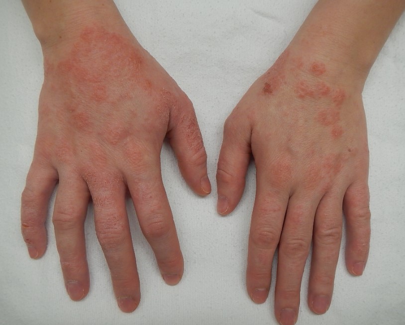 Read more about the article 9 tips on causes, treatment and prevention of eczema