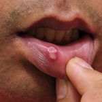 Mouth sores. Do you know the causes and treatment of 3 types of aphthous ulcers?
