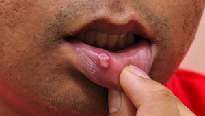 Read more about the article Mouth sores. Do you know the causes and treatment of 3 types of aphthous ulcers?