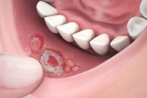 Treatment for mouth sores
