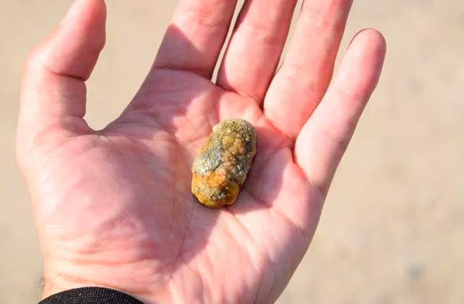 Read more about the article Learn the Symptoms of Gallstones and Useful Information