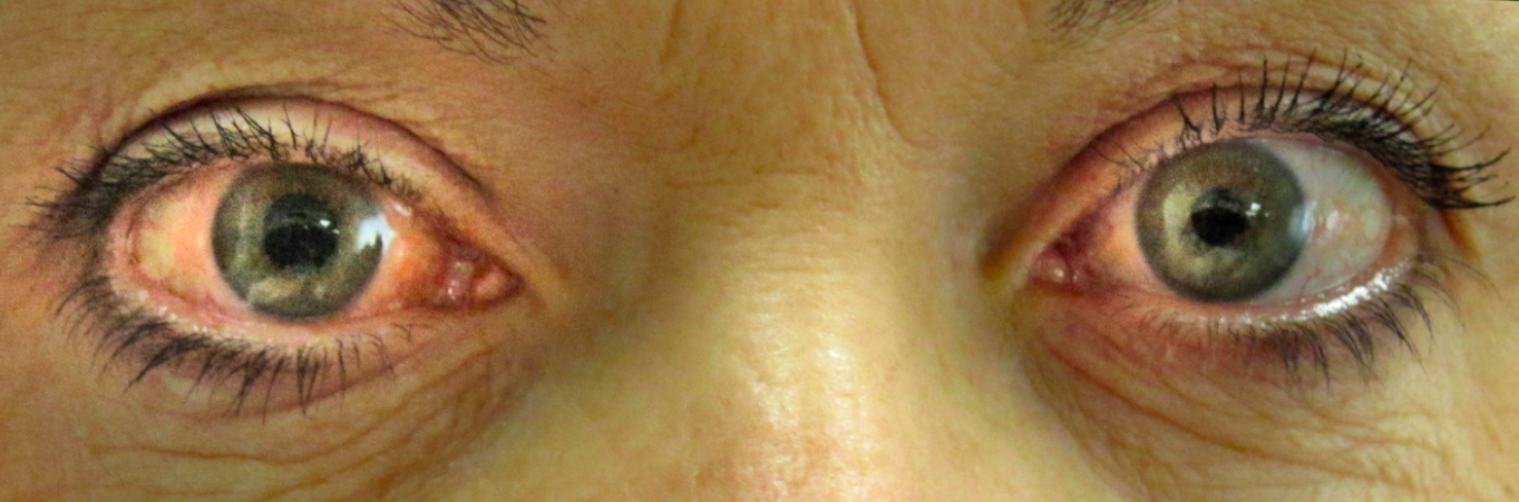 Read more about the article How to take care of glaucoma patients?